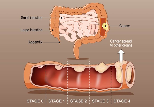 Germany emerges as a leading destination for advanced colon cancer treatment